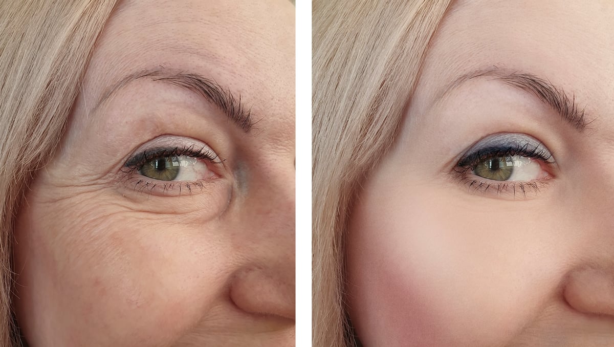 woman eye wrinkles before and after procedures