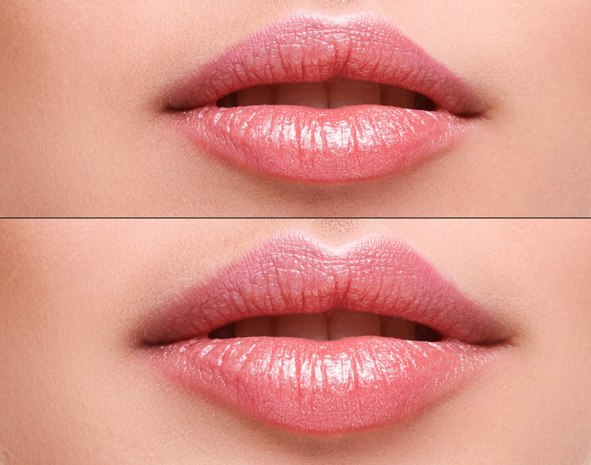 Female lips before and after augmentation