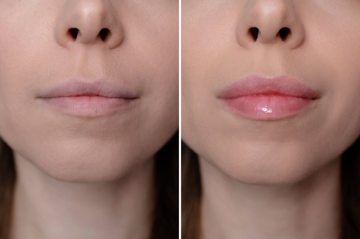 Close up of lips before and after cosmetic procedure