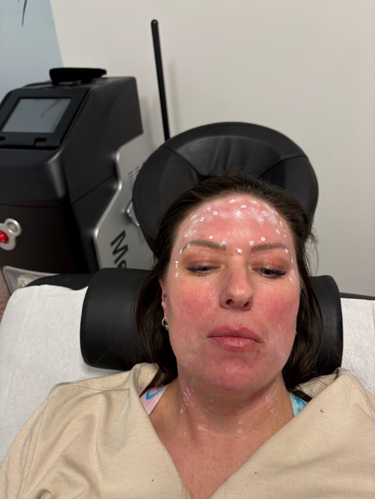 Woman receiving a laser facial treatment with protective headgear and gel on her face in a medical spa setting